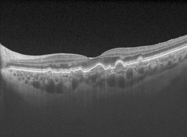 DMAE seca - Tratamiento - Tomografía - VERTE Oftalmología Barcelona