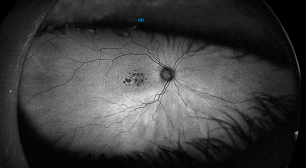 DMAE SECA - Tratamiento - Autofluorescencia - VERTE Oftalmología Barcelona