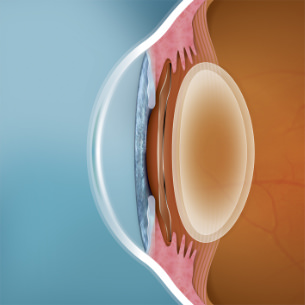 Lente ICL - VERTE Oftalmología Barcelona