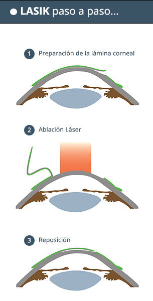LASIK paso a paso - VERTE Oftalmología Barcelona