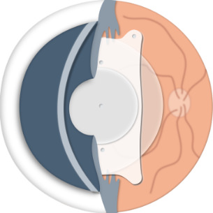 Lentes ICL - Eliminar gafas - VERTE Oftalmología Barcelona