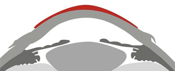 Lentillas o lentes de contacto - VERTE Oftalmología Barcelona