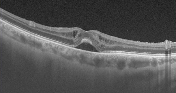OCT Retina - VERTE Oftalmología Barcelona