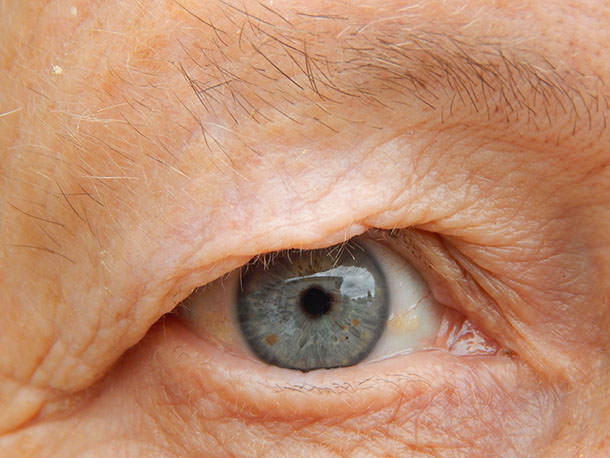 Ojo diabético - VERTE Oftalmología Barcelona