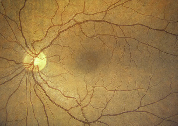 Retinografía - Fondo de ojo - VERTE Oftalmología Barcelona