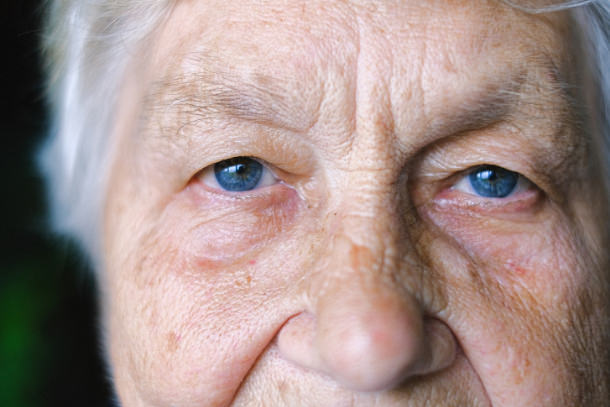 Sindrome Charles Bonnet - Alucinosis - VERTE Oftalmología Barcelona