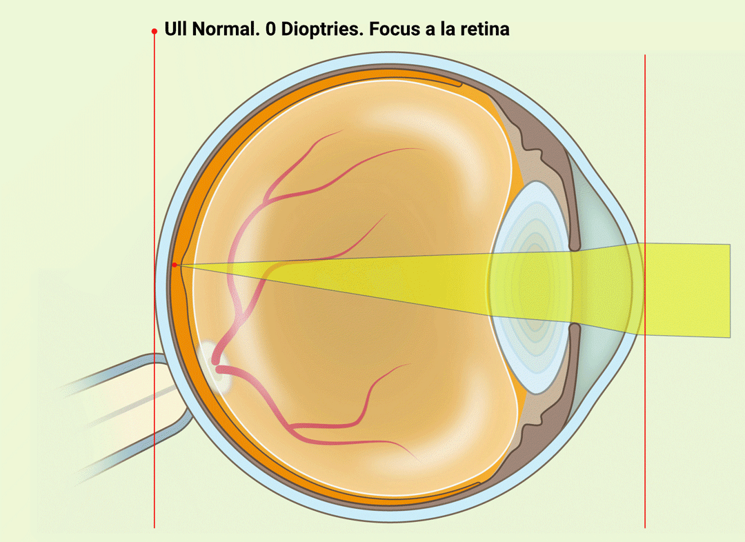 Astigmatisme - VERTE Oftalmologia Barcelona