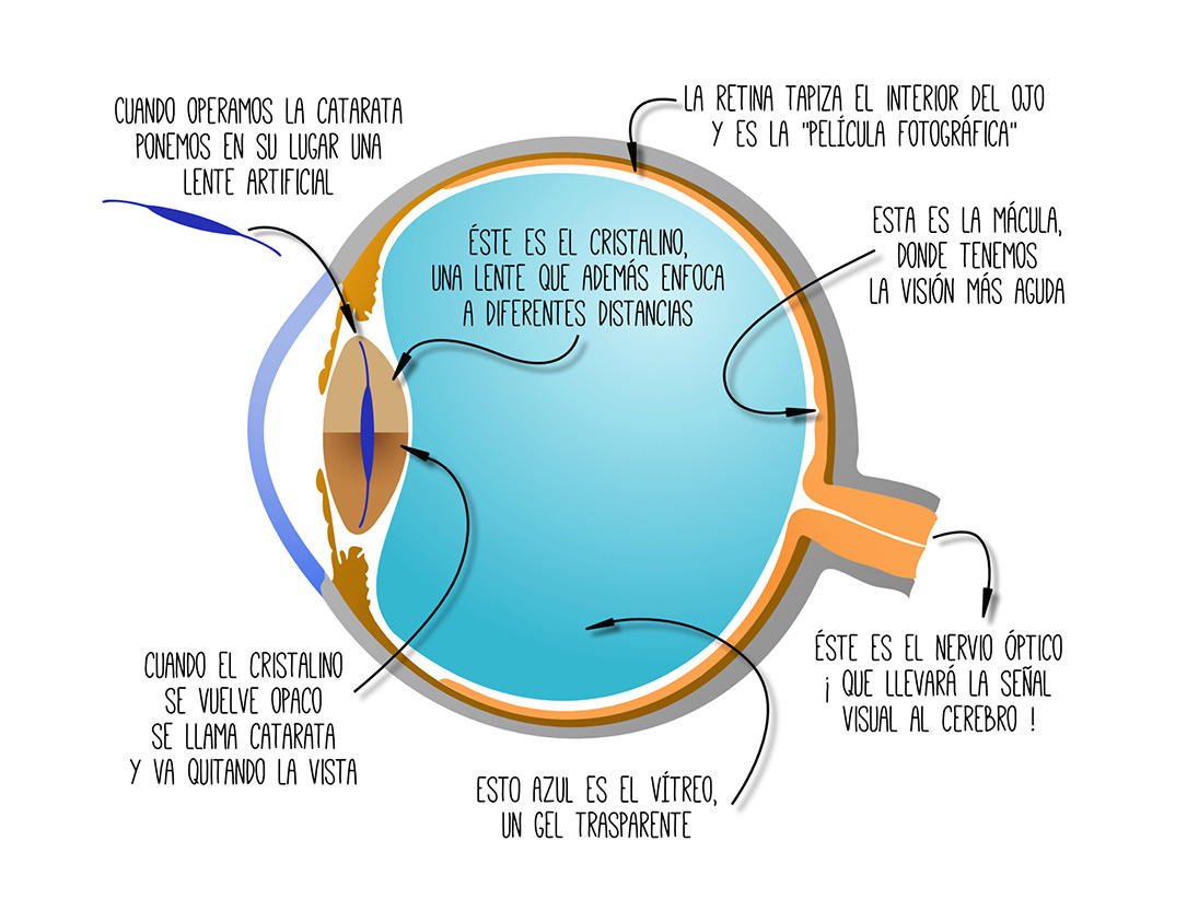 ¿Qué es una catarata ocular? - VERTE Oftalmología Barcelona
