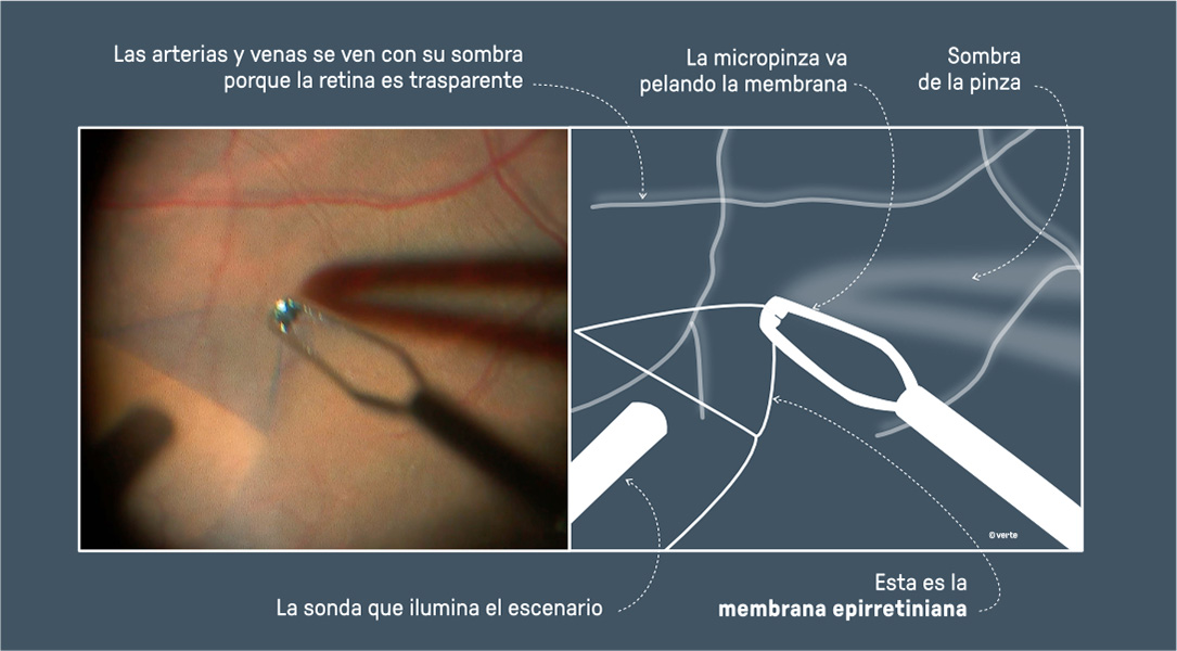 Cirugía Macular - VERTE Oftalmología Barcelona