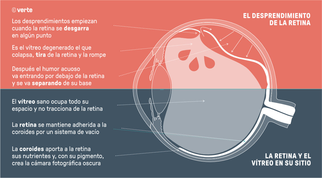 Desprendimiento de retina - Verte Oftalmología Barcelona