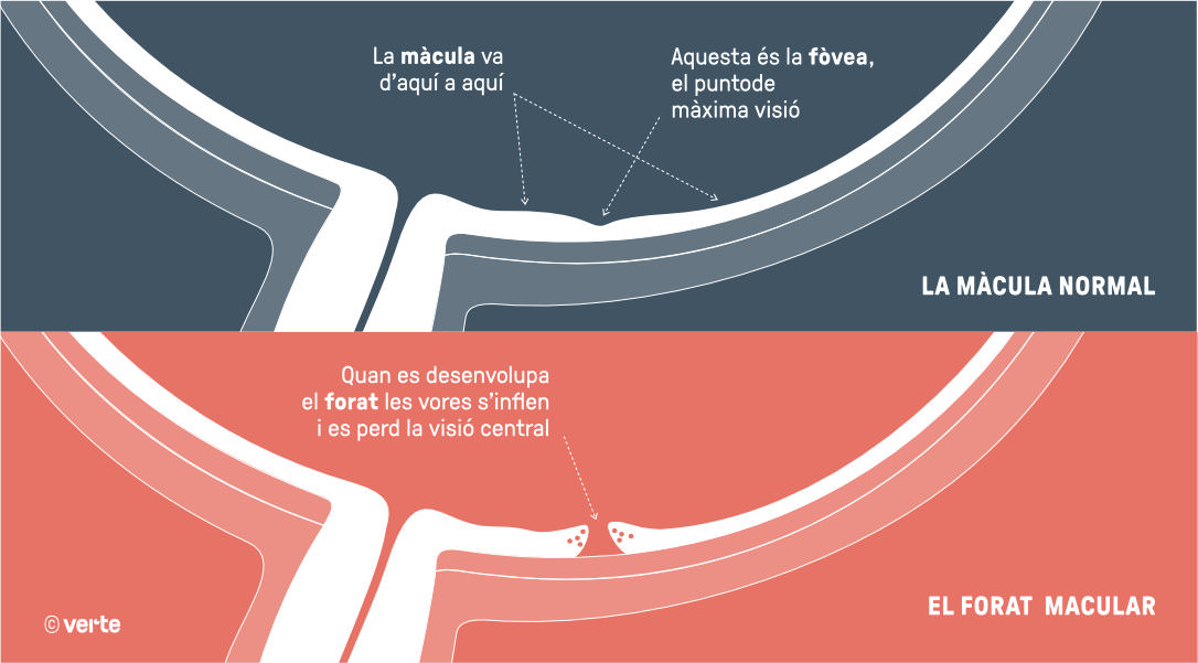 Forat Macular - VERTE Oftalmologia Barcelona