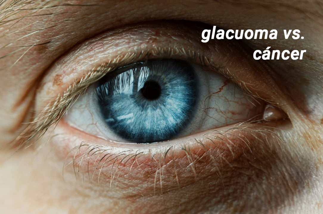 El glaucoma no es un tipo de cáncer - VERTE Oftalmología Barcelona