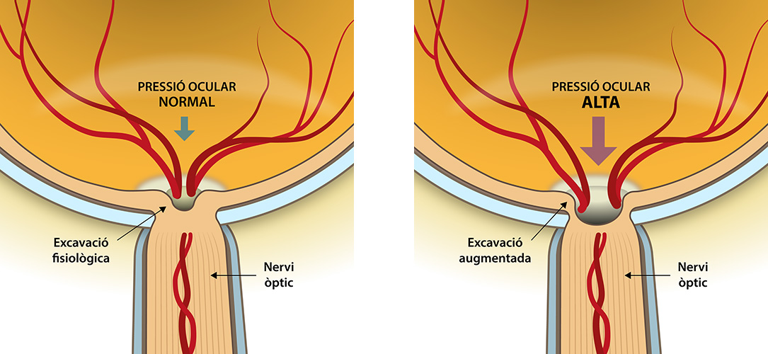 Pressió Ocular Glaucoma - VERTE Oftalmologia Barcelona