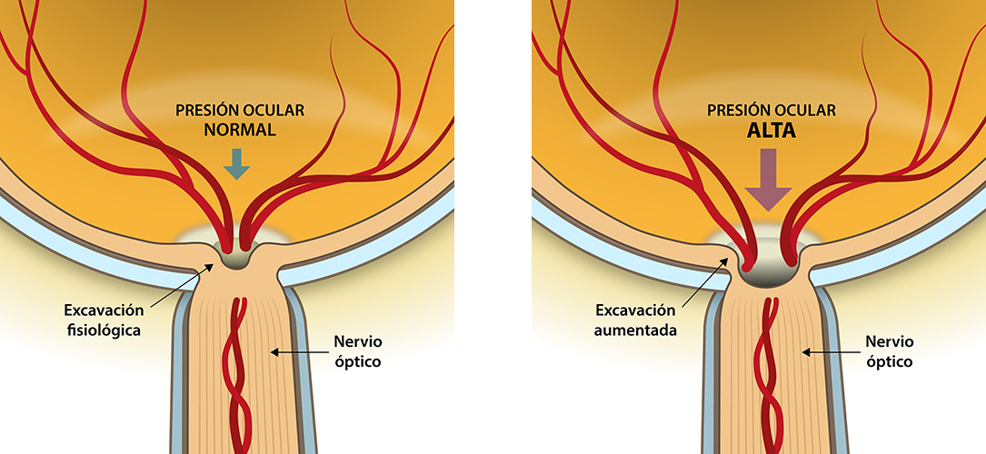 Presión Ocular Glaucoma - VERTE Oftalmología Barcelona