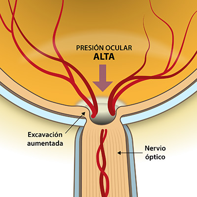 Presión ocular alta - Glaucoma