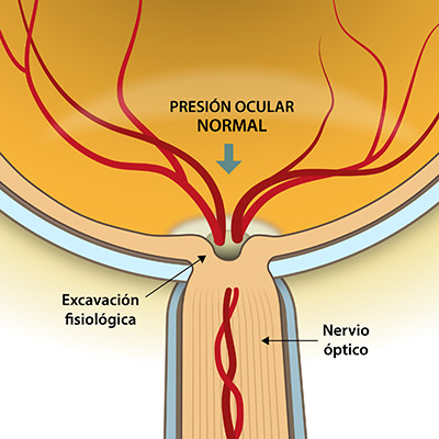 Presión ocular normal - Glaucoma