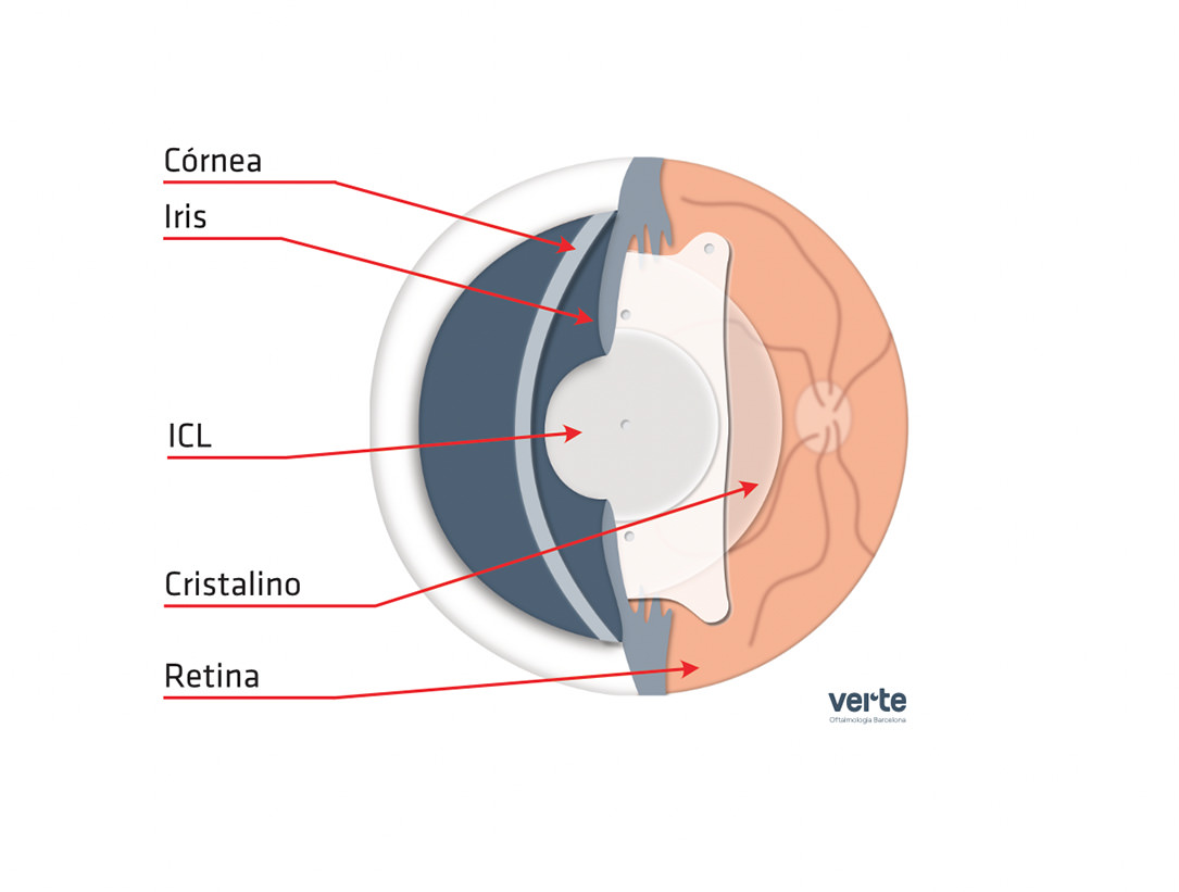 Lente ICL Anatómica