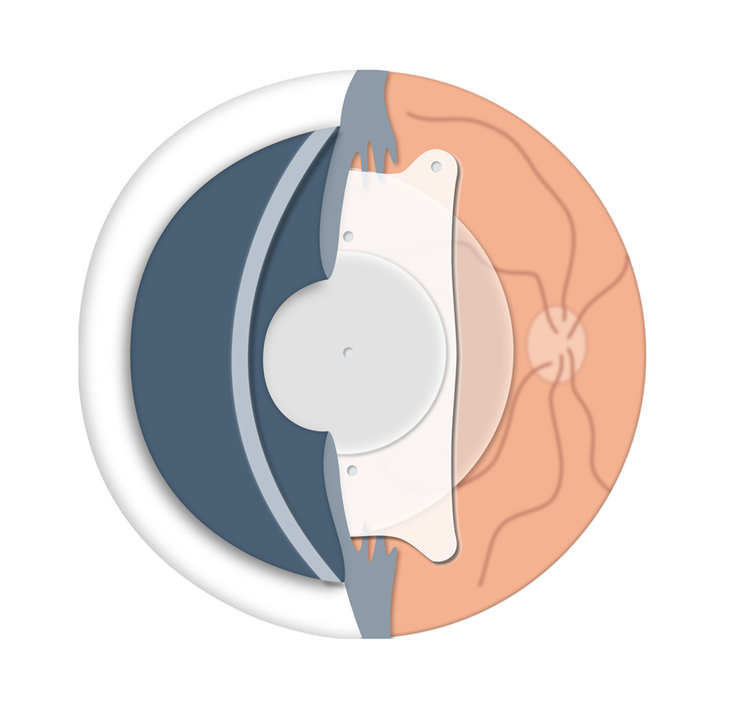 Implantación Lentes ICL - Miopía - VERTE Oftalmología Barcelona