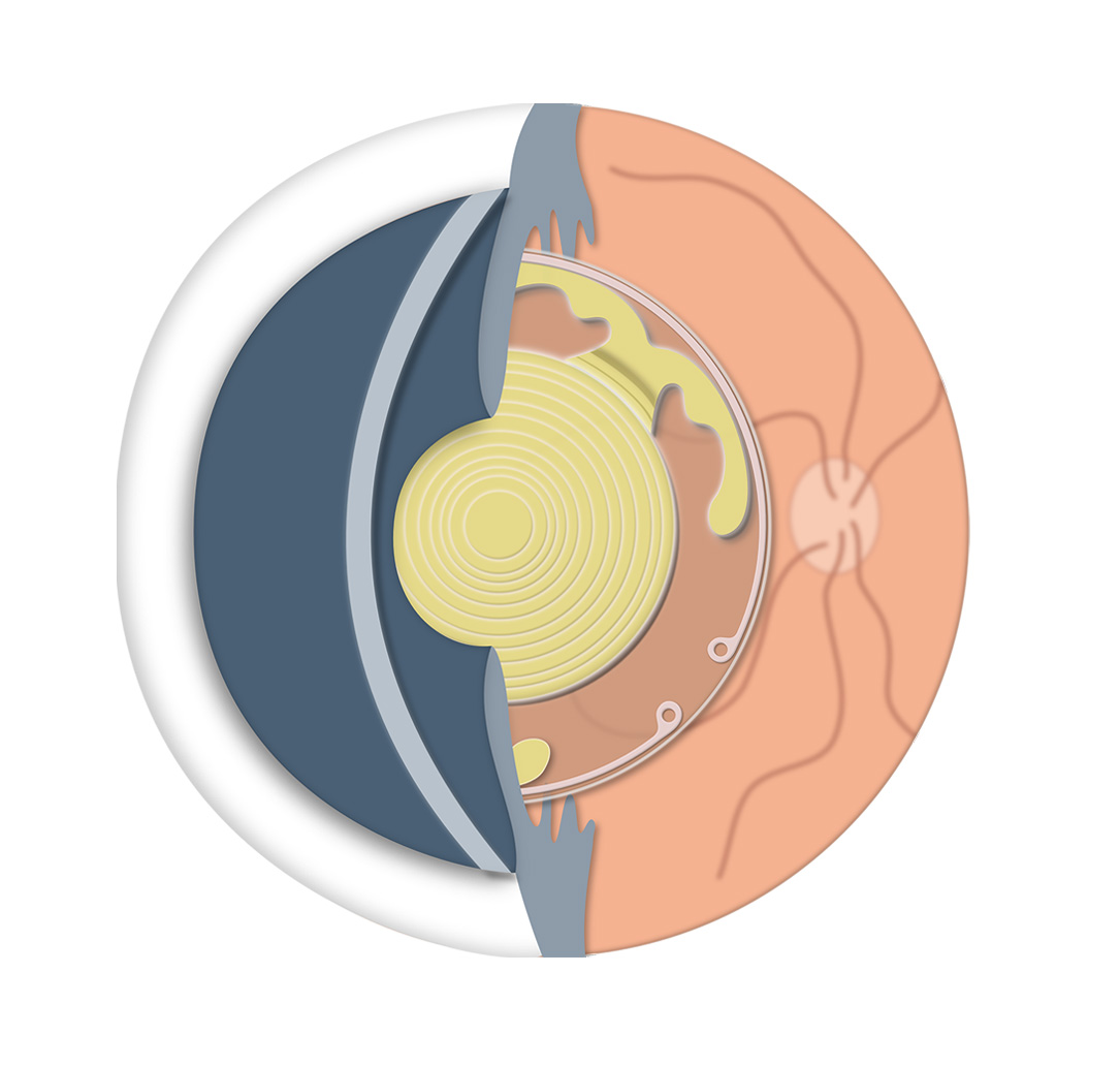 Implantación Lentes Trifocales - VERTE Oftalmología Barcelona