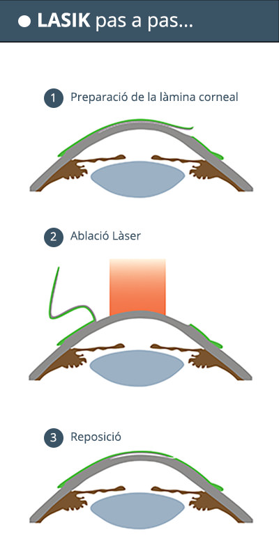CIrugia LASIK Pas a pas - VERTE Oftalmología Barcelona