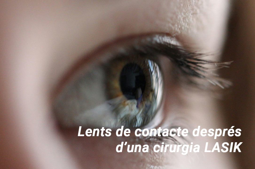 Lents de contacte després del LASIK