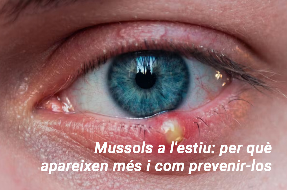 Mussols - Prevenció i tractament a l'estiu - VERTE Oftalmologia Barcelona