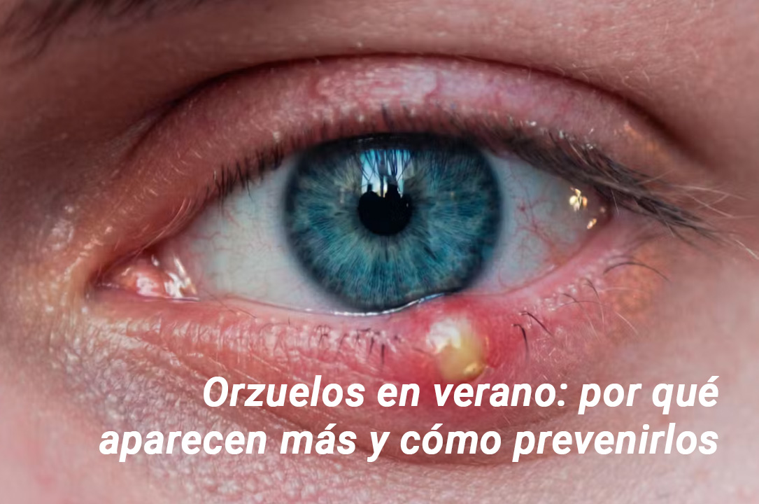Orzuelos - Prevención y tratamiento en verano - VERTE Oftalmología Barcelona