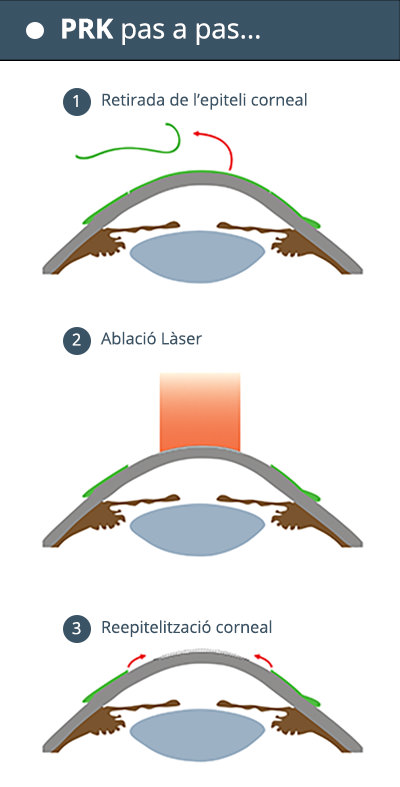 PRK pas a pas - VERTE Oftalmología Barcelona