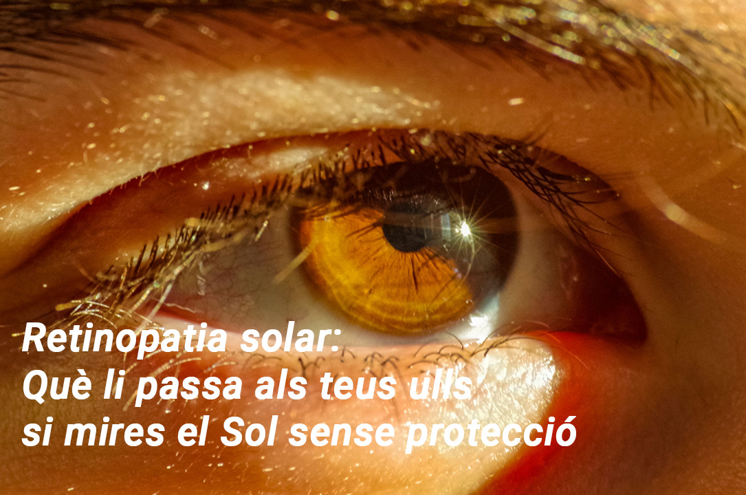 Retinopatia solar - Eclipsi - VERTE Oftalmologia Barcelona
