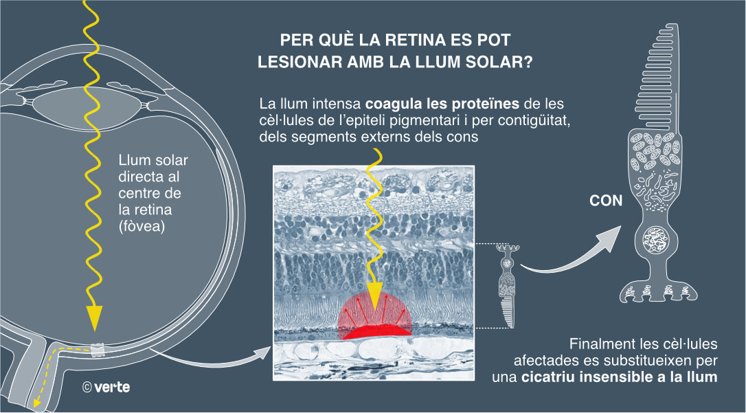 Què és la retinopatia solar?