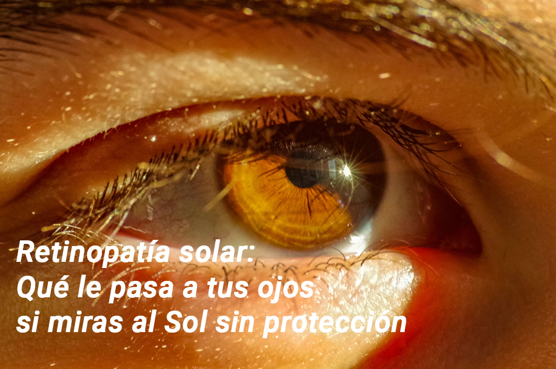 Retinopatía solar - Eclipse - VERTE Oftalmoogía Barcelona
