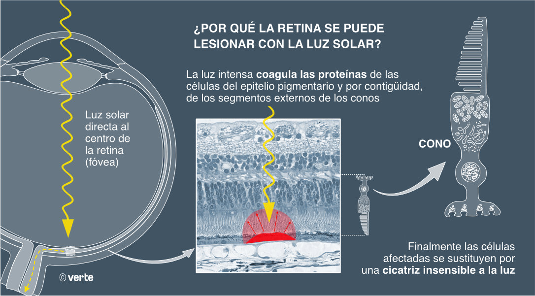  ¿Qué es la retinopatía solar?