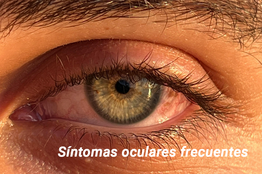 Cuando acudir a Urgencias Oftalmológicas 24h